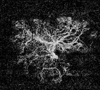 Angio-OCT montrant un réseau néovasculaire choroïdien dans une DMLA exsudative